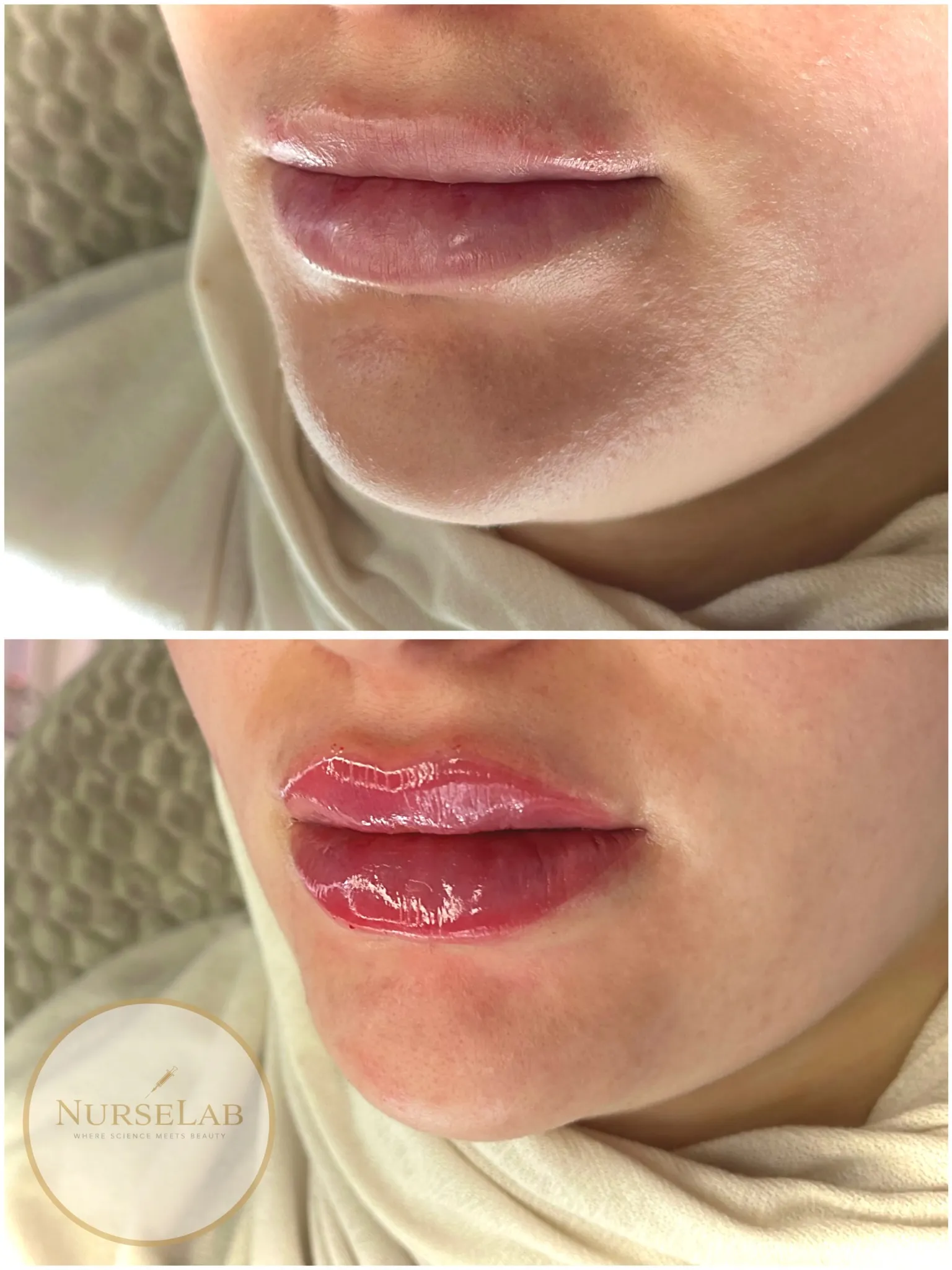 Botox med fokus på kvalitet och service hos Nurselabse AB